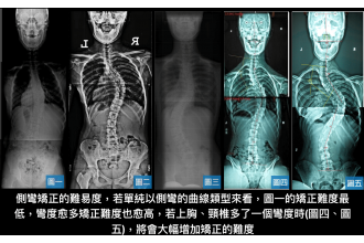 脊椎側彎運動該怎麼做《上》~側彎患者的大腦到底出了什麼問題