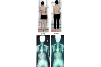 到底脊椎側彎該怎樣治療-從脊椎還是大腦著手