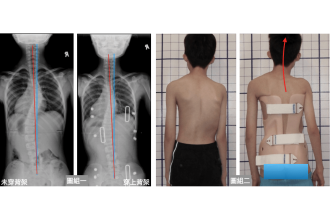不穿脊椎側彎背架的10個理由