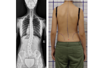 脊椎側彎到底要治療多少次才能看到進步？