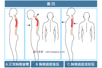 胸椎側彎怎麼辦？了解4大症狀與形成原因，正確矯正沒煩惱！