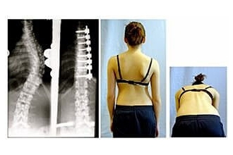 脊椎側彎手術–除了直，還得到了什麼？