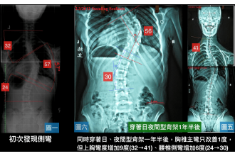 脊椎側彎背架的迷思！迷失？上