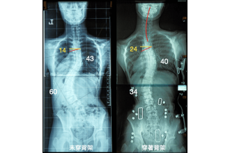 脊椎側彎背架幫了您、還是害了您？？？
