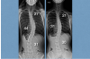 3曲線脊椎側彎案例