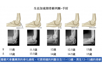 孩子的脊椎側彎何時進入急速惡化期-透過骨頭成長幫您做判斷