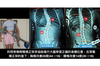 脊椎側彎運動該怎麼做《下》~透過大腦來進行動作學習