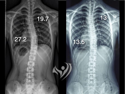 1.5個月胸椎側彎改善13.5度