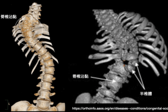 什麼是脊椎側彎？懶人包教你分別兩大側彎種類三大側彎曲線類型