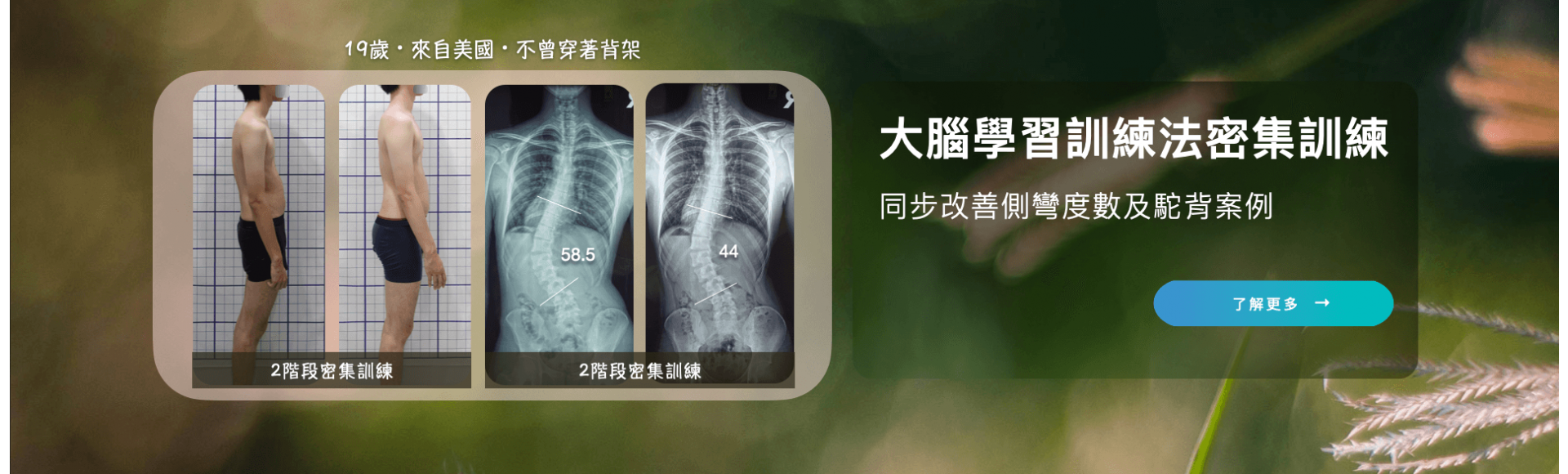 大腦學習訓練法密集訓練-同步改善側彎度數及駝背案例