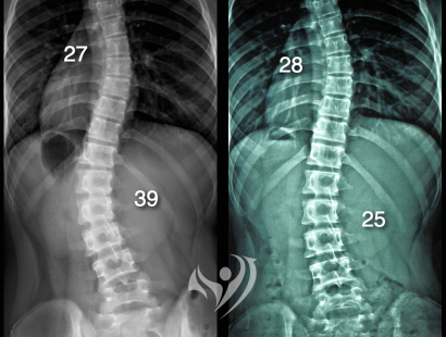 10次改善腰椎側彎