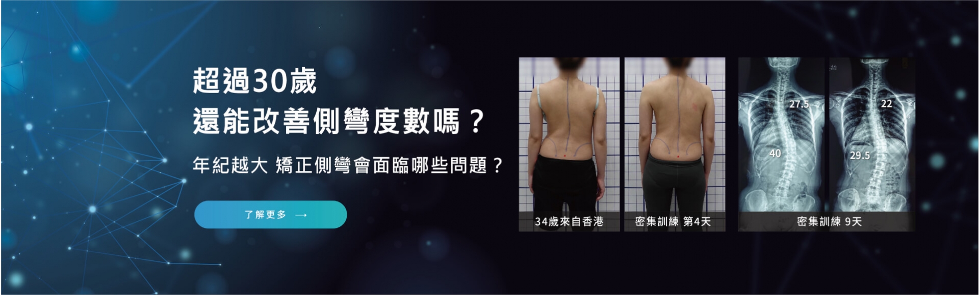 超過30歲還能改善側彎度數嗎？