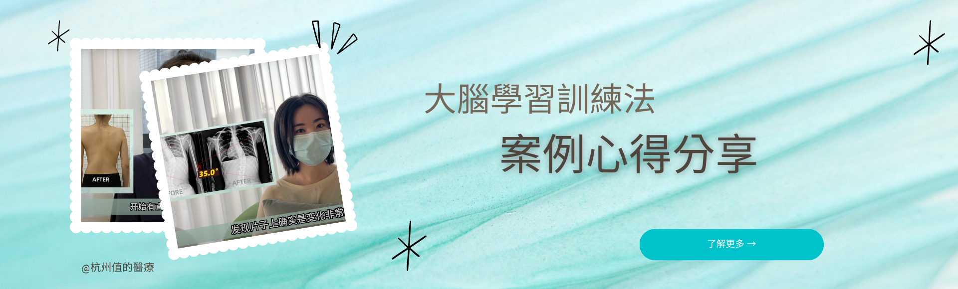 大腦學習訓練側彎矯正法案例心得分享