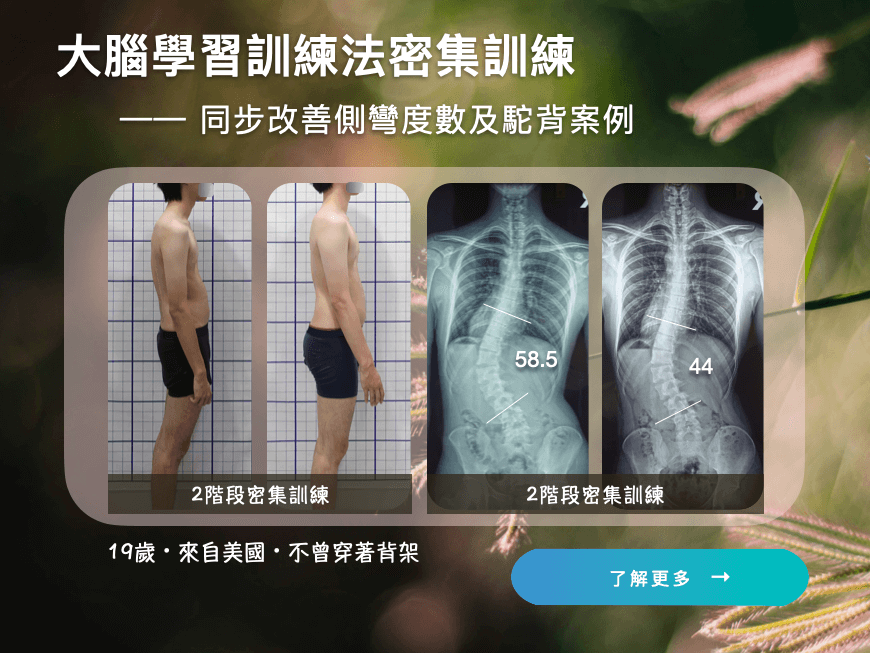 大腦學習訓練法密集訓練-同步改善側彎度數及駝背案例