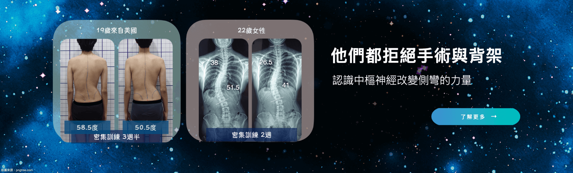 他們都拒絕脊椎側彎手術與背架-大腦學習訓練法脊椎側彎矯正體系與其他側彎矯正體系的差異