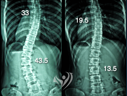 最成功的脊椎側彎矯正案例