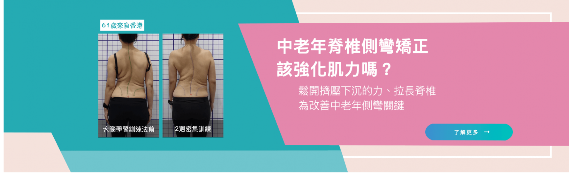 中老年脊椎側彎矯正的關鍵在鬆開擠壓下沉的力並拉長脊椎